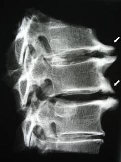 Osteophyten in der Halswirbelsäule verursachen Nackenschmerzen. 