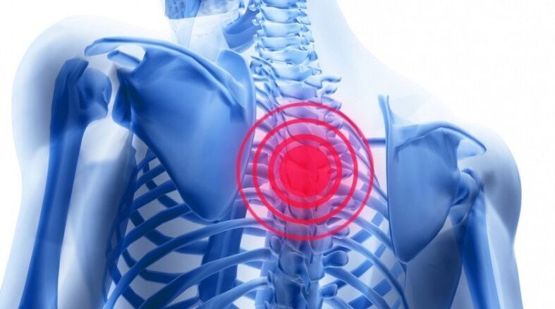 Rückenschmerzen können mit einem Bandscheibenvorfall verbunden sein. 