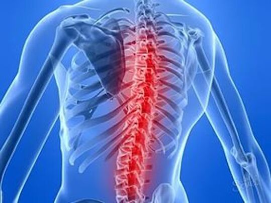 Wirbelsäulenerkrankungen verursachen Rückenschmerzen