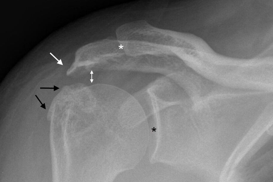 Arthrose des Schultergelenks im Röntgenbild